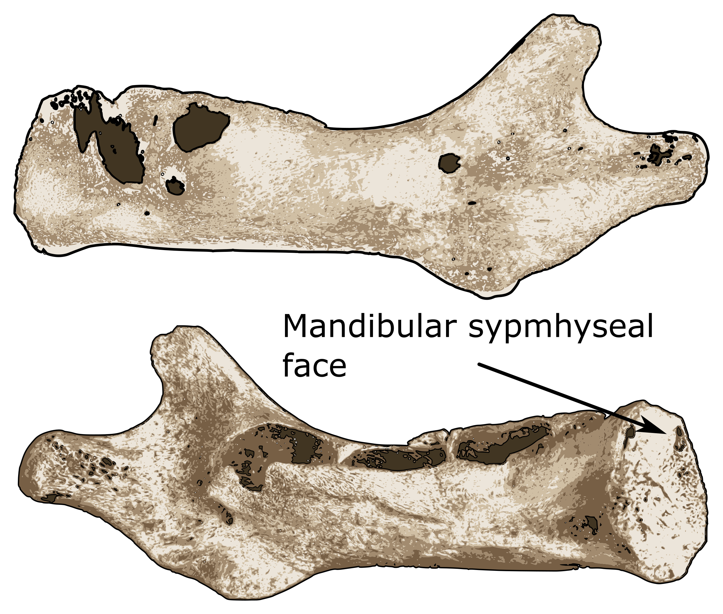 Unfused mandible